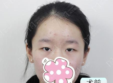 整容会后悔吗(整容后有多少后悔的)