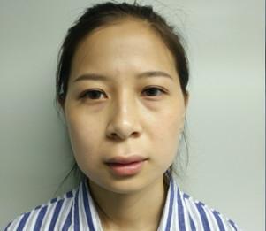大饼脸怎么能瘦成瓜子脸